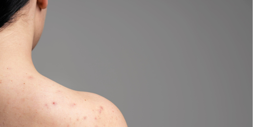 young-woman-showing-the-acne-on-her-shoulders 1.png